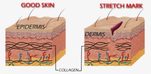 Alteration Of The Dermis, Gives Rise To Stretch Marks - Stretch Marks Cause