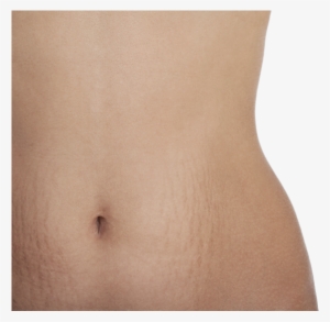 Luckily, Not Everyone Develops Stretch Marks - Navel