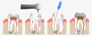 Chico Dentist Root Canal - Root Canal Therapy