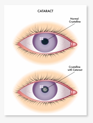 Cataract Symptoms - Redness In Conjunctiva