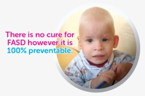 What Is Fasd - Alcohol Syndrome Babies