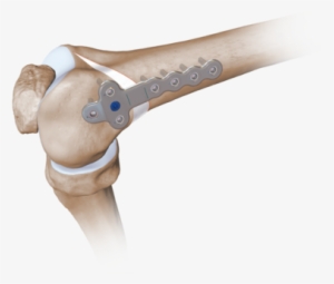 Femoral Opening Wedge Osteotomy Plates 0 Large - Arthrex Distal Femoral Osteotomy