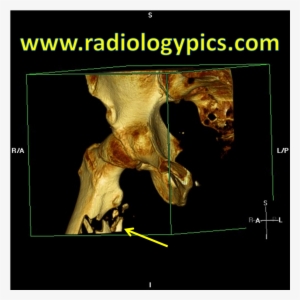 Subtrochanteric Femur Fracture - Millenium Development Goal 7