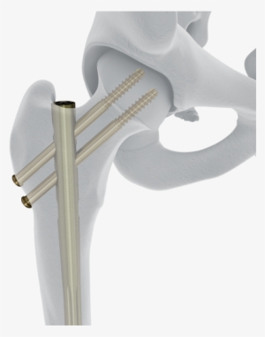Femoral Recon Nail Implanted - Depuy Synthes Companies