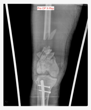21-year Old Male With Compound C3 Fracture Of The Right - Bone Fracture