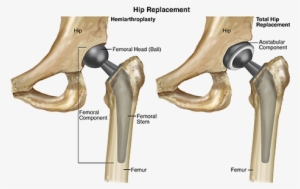Hemiarthroplasty Vs Total Hip Replacement