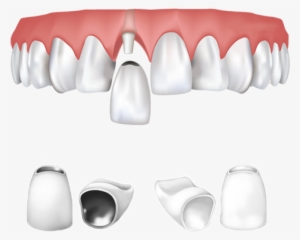 Dental Crowns Types - Dental Crown Png