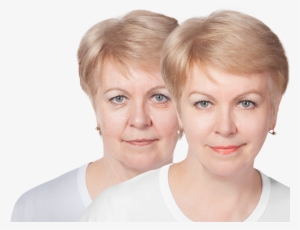 Before And After Image Of Woman's Face After Plastic - Plastic Surgery