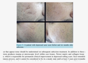 A Patient With Rolling & Icepick Acne Scars Before - Acne