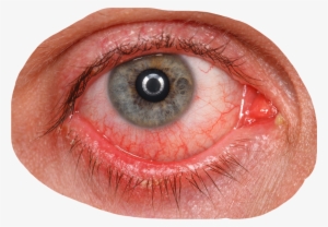 Sign In To Save It To Your Collection - Herpes On Tear Duct