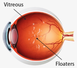 What Are The Symptoms Of A Retinal Detachment - Kodak Uv Blue Lens