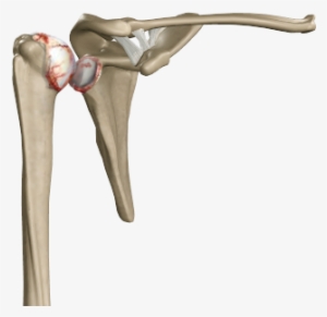 Shoulder Joint Arthritis - Adhesive Capsul Itis