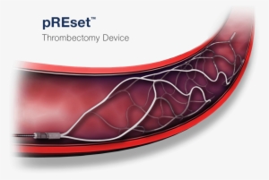 Phenox-preset Thrombectomy Device - Diagram