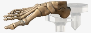 Great Toe Implant - Right First Mtpj Semi Metallic Implant