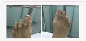 The Presence Of Crossover Second Toe Deformity On Both - Barefoot
