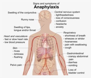 There Are Many Possible Signs Of Anaphylaxis - Anaphylactic Shock