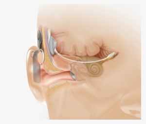 Anatomical View Showing Abi Placement, Which Bypasses - Implante De Tronco Cerebral