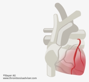 Cardiac Muscle Damage In Acs - Arterial Blood Gas Test
