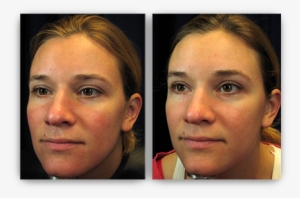 Safely Eliminating Blue Vessels Near The Eye - Laser Treatment For Redness