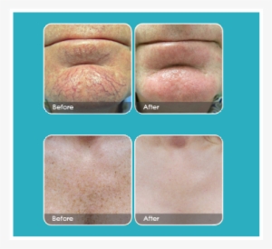 South Florida Vein Aesthetics - Laser