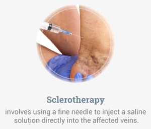 Sclerotherapy - Earth