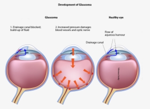 Ophthalmic G-probe™ - Laser Cycloablation