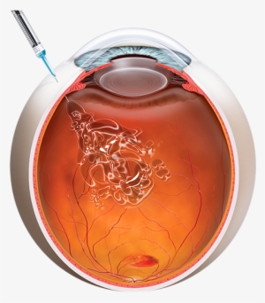 Anti-vegf Injection - Intravitreal Gas Injection