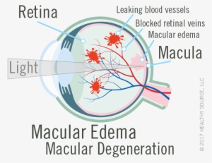 Bleeding, Leaking, And Scarring From The Damaged Blood - Blood Supply To Macular