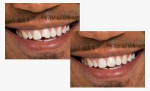 A Before And After Photo Of Dental Bonding - Dental Bonding