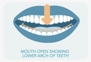 Want To Have An Impressions Doctor See If You're A - Mouth