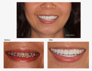 Tetracycline Solutions - Tetracycline Teeth Stain