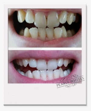 Teeth Whitening Before And After Photos From A Pearly - Home Teeth Whitening