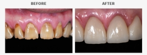 This Patient Suffered From Worn And Eroded Dentition, - Colorfulness