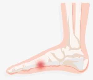 Common Treatments Include New Shoes, Arch Supports, - Sock