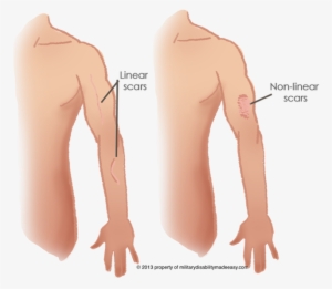 Linear Scar 1 - Linear Scar