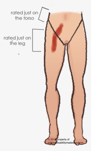 Scar Example 4 - Kidney Transplant Scar On Leg