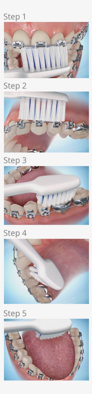Brushing Steps - Petaluma Orthodontics - Brush Your Teeth When You Have Braces