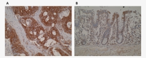 Immunohistochemistry Images Are Showing A Strong Cytoplasmic - Floor