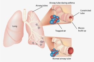 Lungs During Asthma Attack - People With Asthma And Smoking