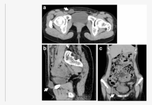 Computed Tomography Scans Showing A Round Cystic Lesion - Computed Tomography