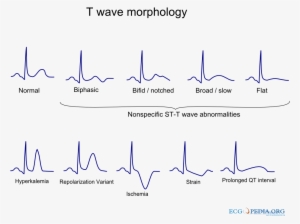 T Wave Morphology