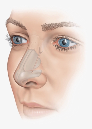 Patients Who Have Experienced Nasal Obstruction From - Nose Implant