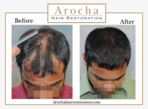Fut Hair Transplant Texas - Hair Transplantation