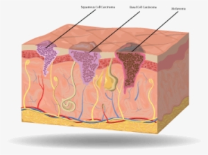 Large Skin Cancer Cell - Box