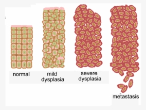 Progressive Increases In Cell Division And Abnormal - Cancer Cell
