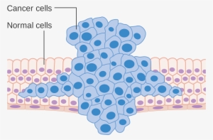Why Haven't We Cured Cancer Yet A Report From The Forefront - Cancer Cells Metastasis