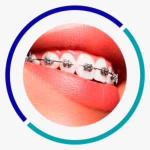 Orthodontics - Dental Braces Price In Qatar