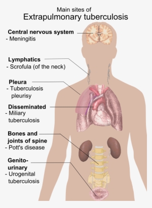 Extrapulmonary Tuberculosis Symptoms - Main Sites Of Extrapulmonary Tuberculosis