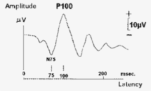 The Wave Pattern Of Pr-vep - Wave