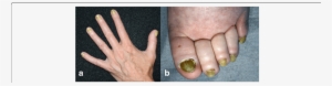 Yellowing Of All 10 Finger And (b) Toe Nails - Yellow Nail Syndrome
